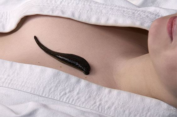 гирудотерапия при заболеваниях системы кровообращения гирудотерапия при заболеваниях системы кровообращения