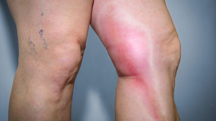 озонотерапия при тромбофлебите озонотерапия при тромбофлебите