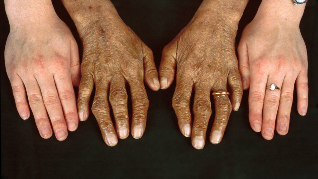 болезнь Аддисона