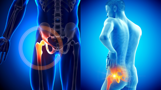 Анкілоз тазостегнового суглоба