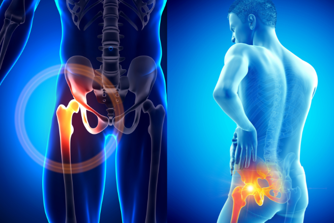 Анкілоз тазостегнового суглоба